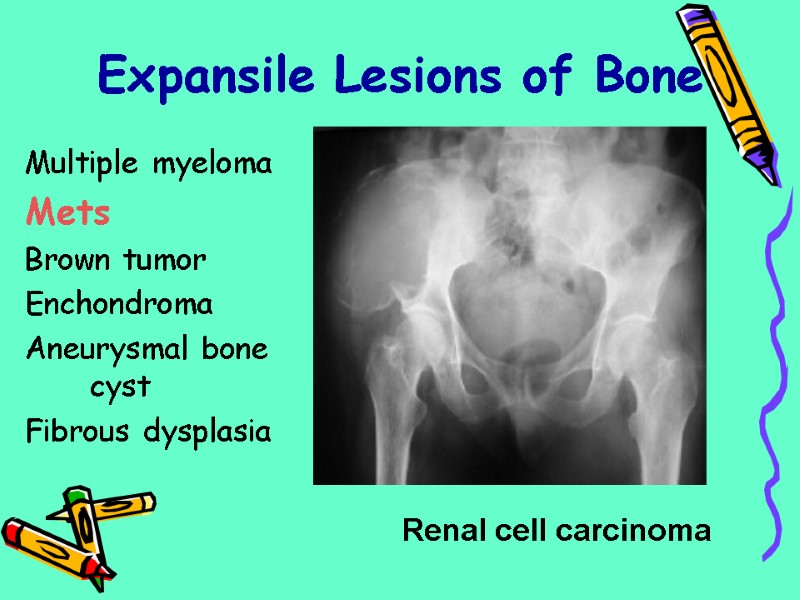 Multiple myeloma  Mets Brown tumor Enchondroma Aneurysmal bone cyst Fibrous dysplasia  Expansile